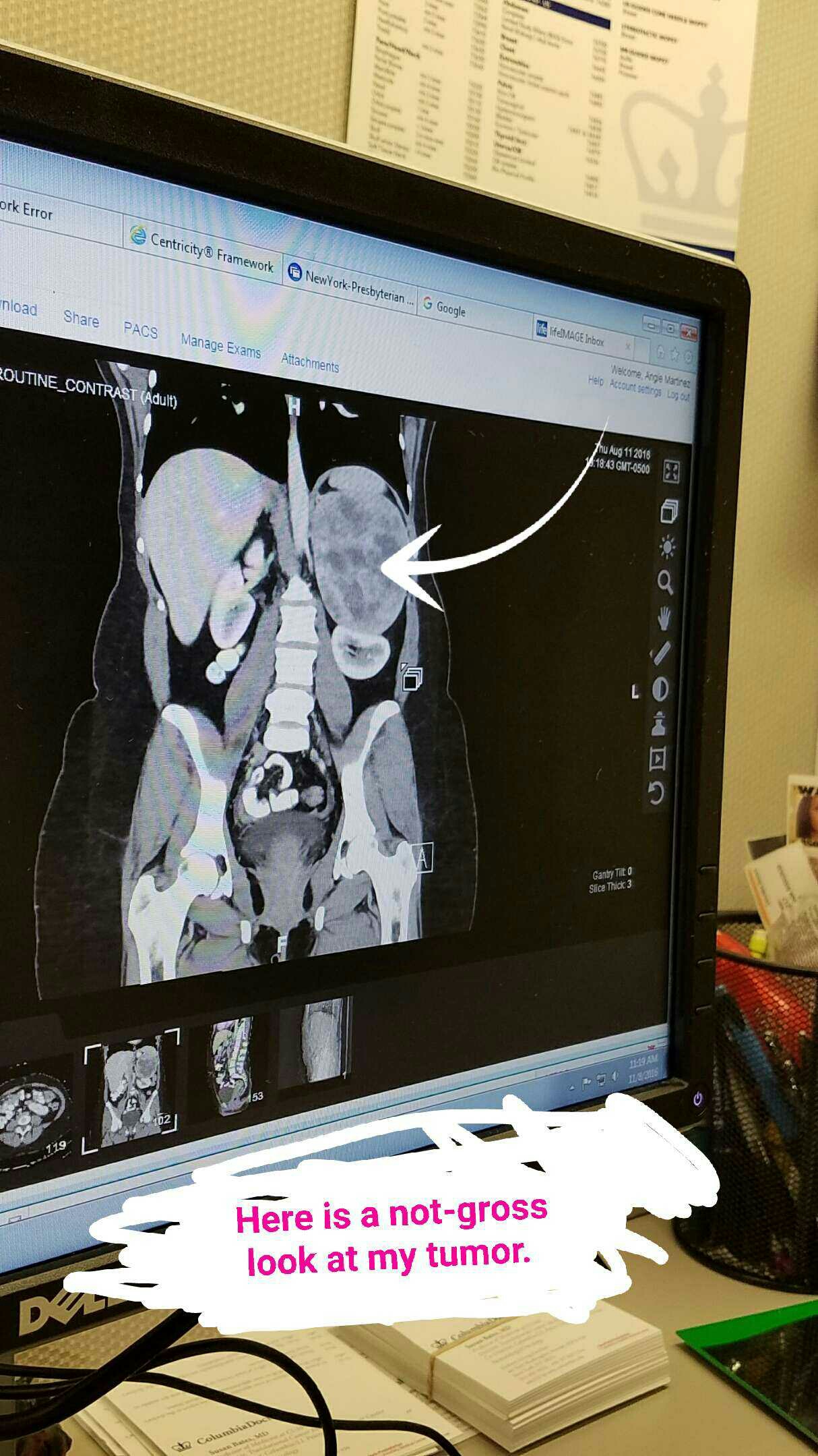 That splotchy thing? My giant tumor.